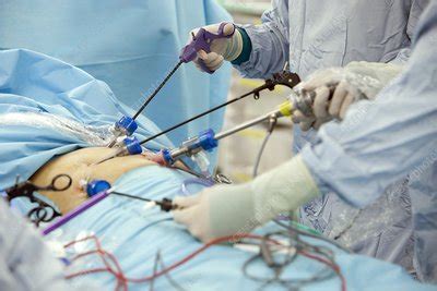 Gall bladder removal surgery - Stock Image - C011/4468 - Science Photo Library