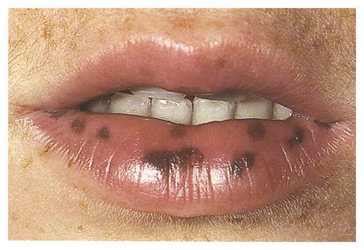 Medical Treatment For Black Spots On Lips | Lipstutorial.org