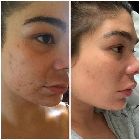 28 Skincare Products With Dramatic Before & After Photos