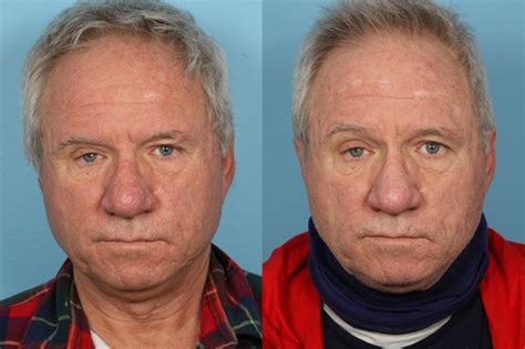 Rhinophyma Treatment | Plastic Surgery Chicago,IL |Dr. Sidle