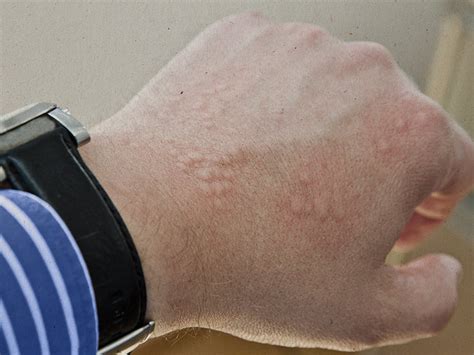 Rashes that look like scabies: Causes, symptoms, and treatment