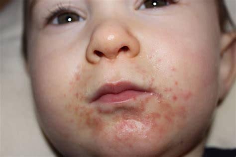 What Can Cause A Rash Around A Child's Mouth | Other Allergies