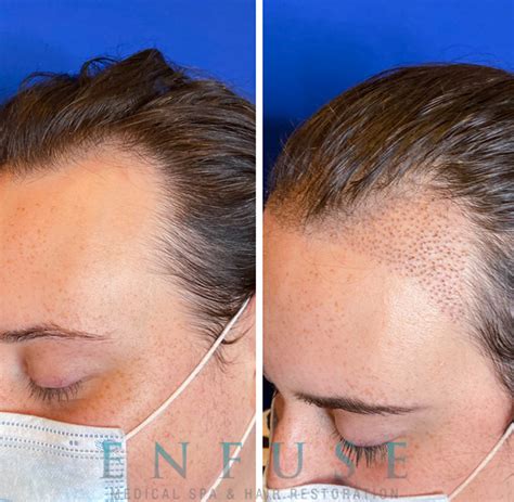 Hairline Feminization | Chicago | Enfuse Medical Spa