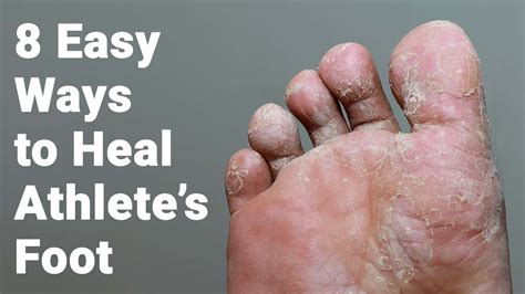 8 Easy Ways to Heal Athlete’s Foot