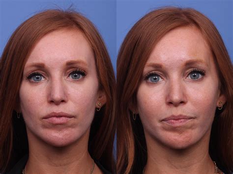 Cheek Implant Before and After Photo Gallery | Scottsdale, AZ | Hobgood Facial Plastic Surgery ...