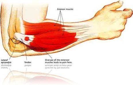 Tennis elbow, Tennis elbow exercises, Elbow pain