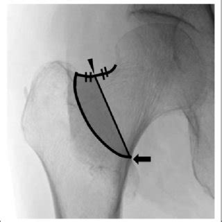 Definitions of Basicervical Fracture in Previous Studies Since Blair's ...