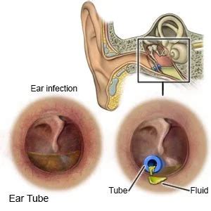 What Are Tubes In Your Ears? - Denison Hearing