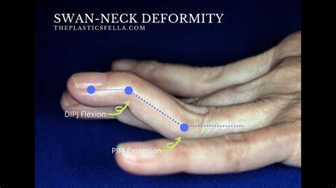 Wemed Swan Neck Deformity 3D Printed Splint - YouTube