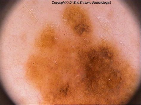 dermoscopy: Atypical (dysplastic) nevus