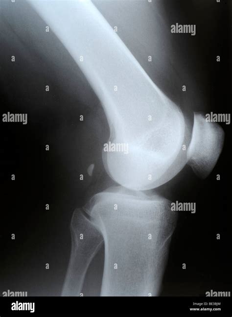 X-ray of the knee, lateral, fabella, sesamoid bone (Os sesamoideum musculi gastrocnemii Stock ...