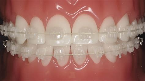 Clear Ceramic Braces In Fort Collins For Adults Use - bitbitbyte