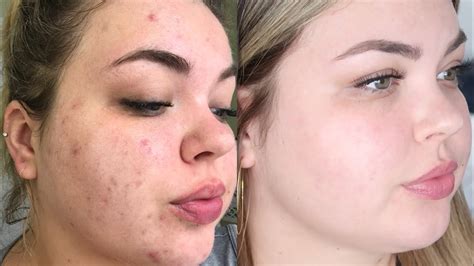 Before After Accutane Before After - vrogue.co