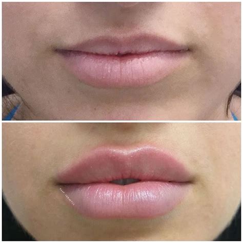 crosemail.blogg.se - Lip filler swelling stages