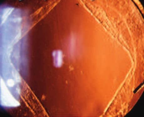 Posterior Capsular Opacification: Frequently Asked Questions - YAG Laser