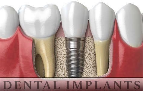 Treatment of Dental Implant Complications – Perio Arts Colorado