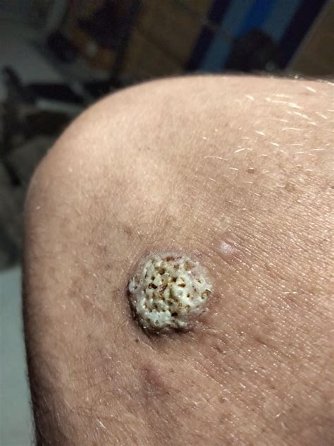 Not a wart but looks like one, near my elbow : r/Warts