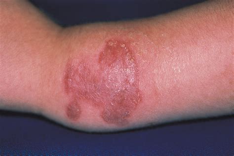 Skin Ulcers Associated With a Tender and Swollen Arm | Dermatology ...