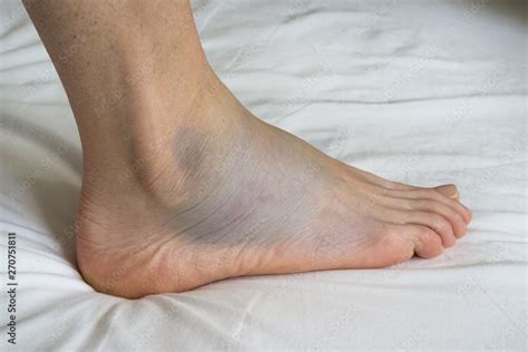 Sprained ankle with bruise adn swelling, female right foot 스톡 사진 | Adobe Stock