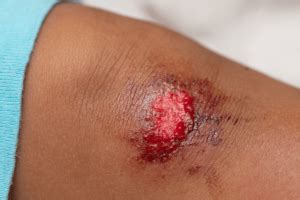 What are the Different Types of Wounds? - LFA First Response