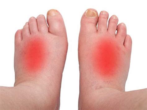 Foot Cellulitis – Royal Podiatry