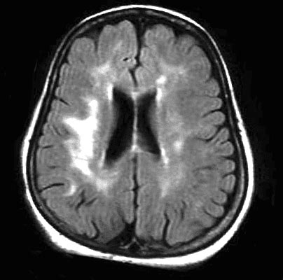 Cerebrovascular disease - Leukoaraiosis | Institut Chiari & Syringomyelia & Scoliosis Barcelona