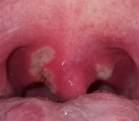 Sore Throat For 3 Weeks - ENTAdvice.net