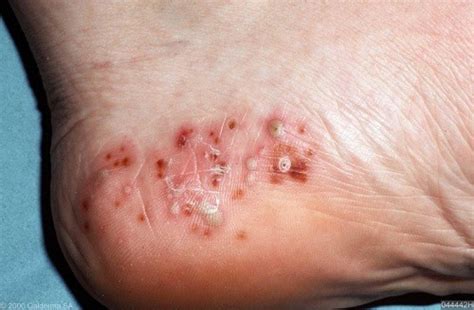 Pustular Psoriasis Treatment and Symptoms - Hickey Solution