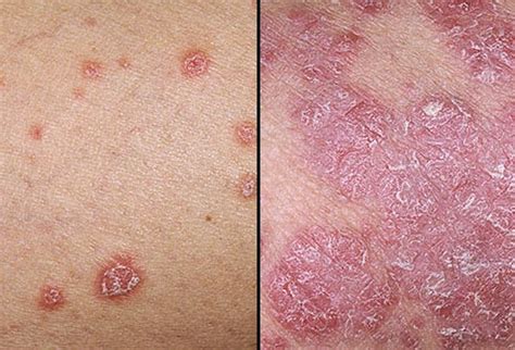 Pengertian tentang "Apa sih Penyakit Kulit Psoriasis itu?"