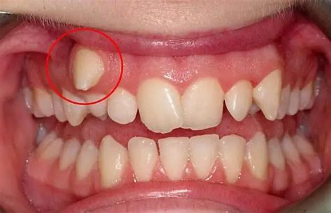 Tooth supernumerary: causes, symptoms and features of treatment | Dentistry 2024