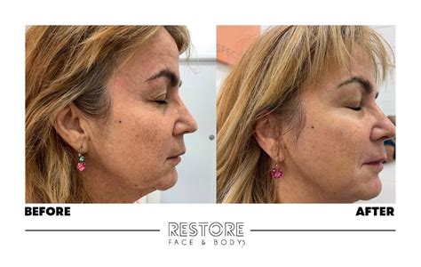 HIFU, Before and after treatment — Restore Face and Body | 4D HIFU Treatment Specialists