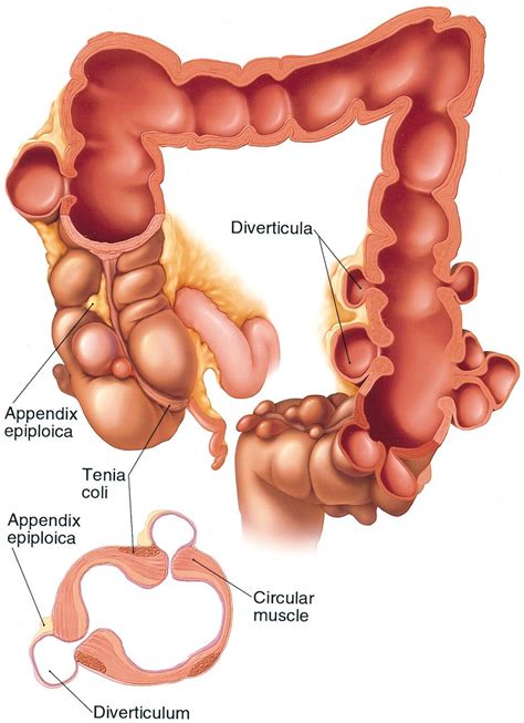 Diverticulitis — Suncoast Surgical Associates