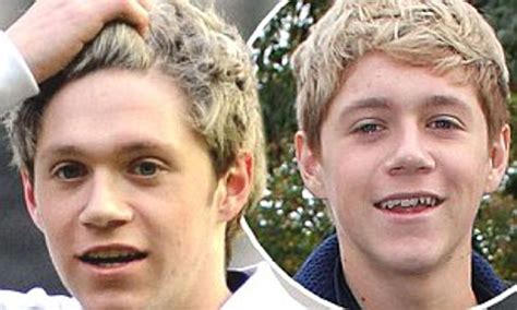 Niall Horan Smile Before After