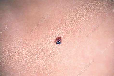 Dysplastic Nevus - Stock Image - C043/0703 - Science Photo Library