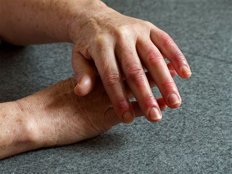 Arthritis in fingers: What does it feel like? Causes and treatment