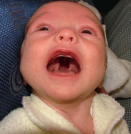 Cleft Palate | Cleft Lip and Palate | Cleft Palate Causes | Cleft ...