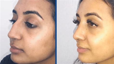 Rhinoplasty (Nose Job) Before & After Photos | Centre for Surgery