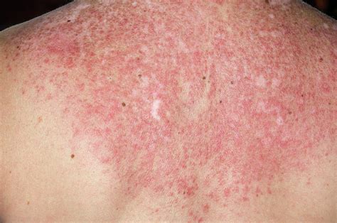 Lupus Rash On Back Triggered By Sun Photograph By Dr P Marazzi Science ...