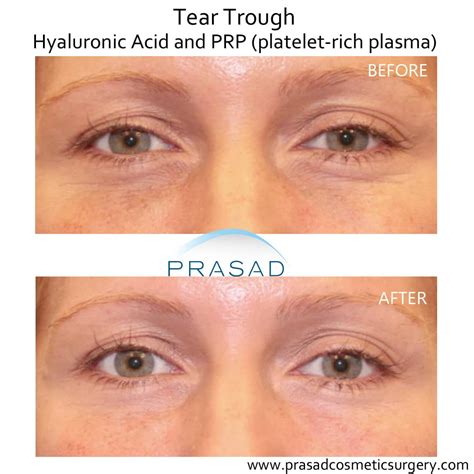 Under Eye Filler Before and After Photos - Prasad Cosmetic Surgery NY