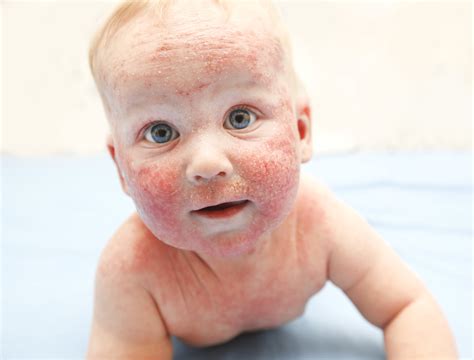 Is It a Rash or Baby Acne? - WeHaveKids