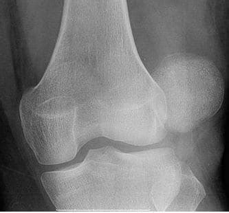 The Grades of Patellar Luxation in Dogs - Dog Discoveries