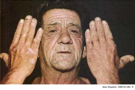 Skin manifestations of liver diseases | Annals of Hepatology