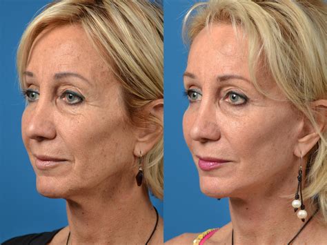 FaceLift - Everything to Know About Face Lifts - Health Costa Rica