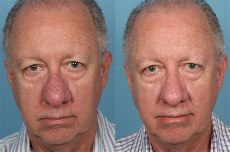 Before and After - Rhinophyma |Dr. Sidle