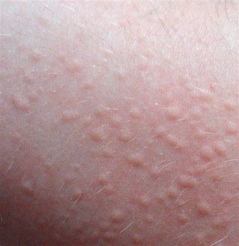 Skin Rash Types Causes Tests And More | Sexiz Pix