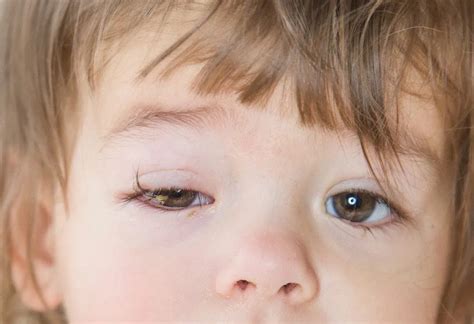 Conjunctivitis In Infants & Children: Causes, Symptoms & Treatment