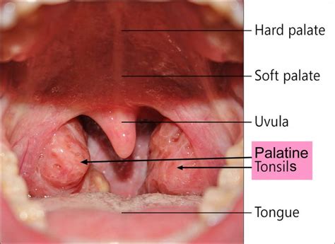 Peritonsillar abscess causes, signs, symptoms, diagnosis and treatment