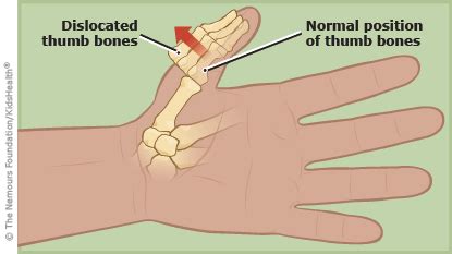 A to Z: Dislocation, Thumb (for Parents) - Nemours