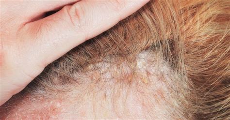 Scalp psoriasis: Shampoos, home remedies, and causes