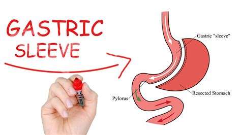 Is Gastric Sleeve Surgery Safe? All About Safety, Risk, and Reward